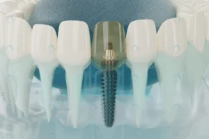 close up component dental implants transparent 3d crc0ce75122 size13.06mb 7800x5200 - title:Home - اورچین فایل - format: - sku: - keywords: p_id:18