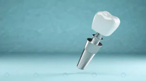 dental implant dental prosthesis 3d rendering crc3c50896a size2.27mb 5396x3000 - title:Home - اورچین فایل - format: - sku: - keywords: p_id:18