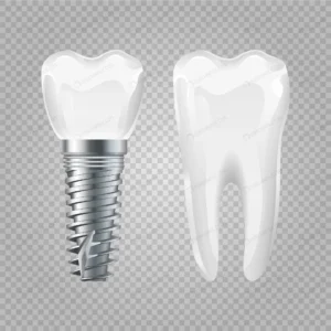 dental implant realistic healthy tooth implant de crc557a9647 size1.41mb - title:Home - اورچین فایل - format: - sku: - keywords: p_id:18