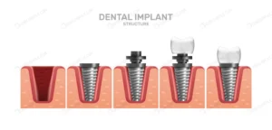 dental implant structure full placement steps rea crcb1fc8369 size3.34mb - title:Home - اورچین فایل - format: - sku: - keywords: p_id:18