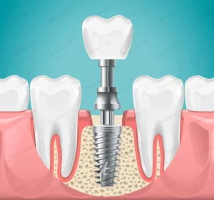 dental surgery tooth implant cut illustration hea crc01aa471f size2.15mb - title:Home - اورچین فایل - format: - sku: - keywords: p_id:18