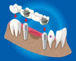 isometric prosthetic dentistry concept with denta crc4370637a size2.18mb - title:Home - اورچین فایل - format: - sku: - keywords: p_id:18