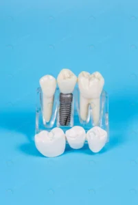 plastic dental crowns imitation dental prosthesis crcf0da4002 size8.82mb 3408x5088 - title:Home - اورچین فایل - format: - sku: - keywords: p_id:18