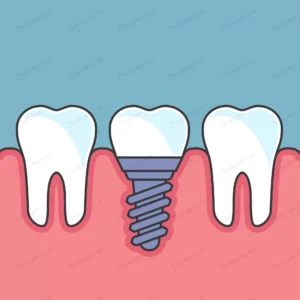 row teeth with dental implant dental prosthetics crcb61db7bf size0.99mb - title:Home - اورچین فایل - format: - sku: - keywords: p_id:18