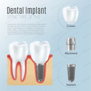 structure dental prosthetics infographics crcc56b2fe0 size3.31mb - title:Home - اورچین فایل - format: - sku: - keywords: p_id:18