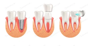 teeth procedure implant veneer crown restoration crc0e2e45e2 size2.11mb - title:Home - اورچین فایل - format: - sku: - keywords: p_id:18